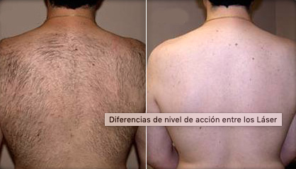 dep laser testimonial