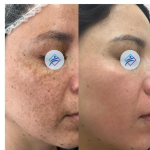 Depigmentation Treatment 2 sessions