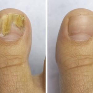 Tratamiento para hongos en las uñas